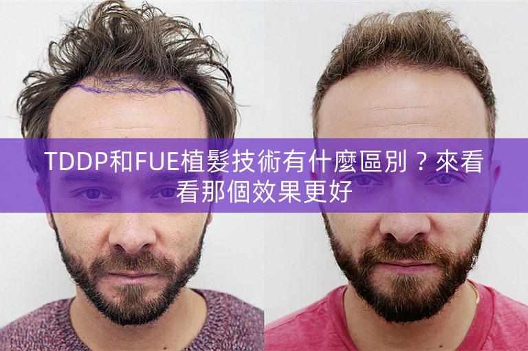 TDDP和FUE植髮技術有什麼區別?來看看那個效果更好 TDDP和FUE植髮技術有什麼區別?來看看那個效果更好
