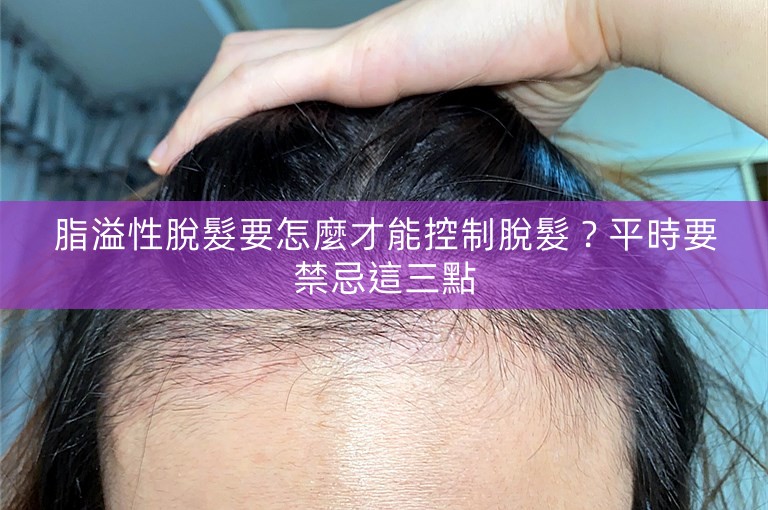 脂溢性脫髮要怎麼才能控制脫髮？平時要禁忌這三點