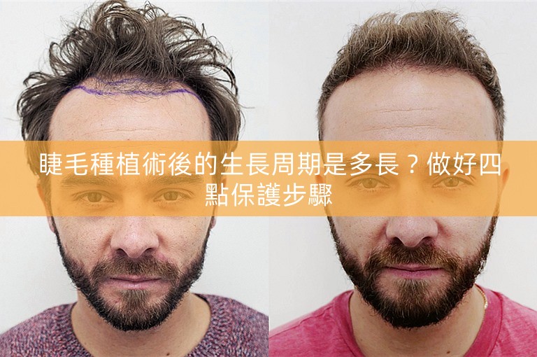 睫毛種植術後的生長周期是多長？做好四點保護步驟