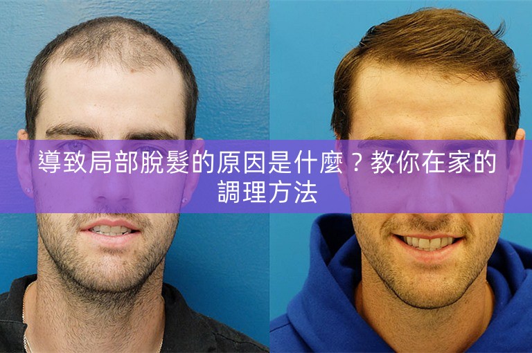 導致局部脫髮的原因是什麼？教你在家的調理方法