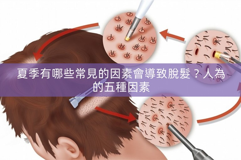 夏季有哪些常見的因素會導致脫髮?人為的五種因素 夏季有哪些常見的因素會導致脫髮?人為的五種因素