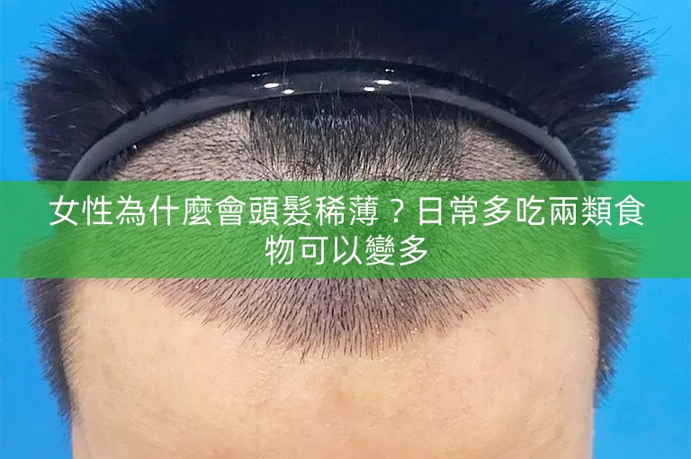 女性為什麼會頭髮稀薄？日常多吃兩類食物可以變多