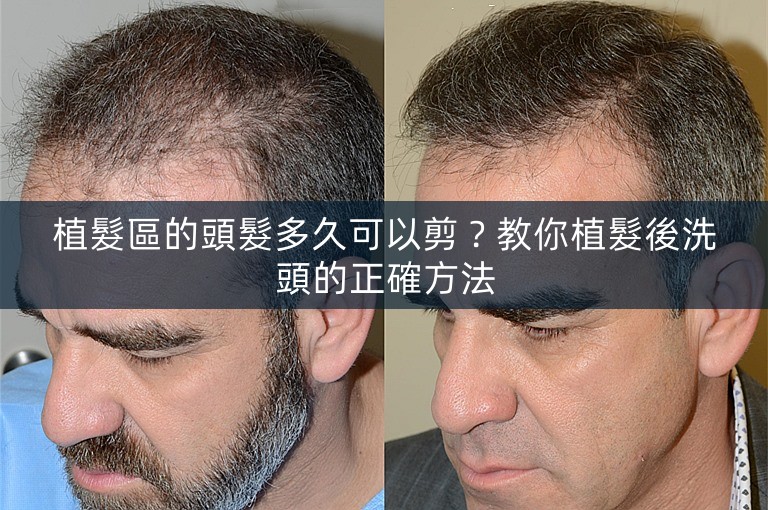 植髮區的頭髮多久可以剪？教你植髮後洗頭的正確方法
