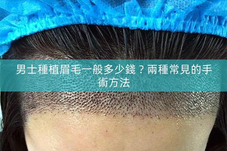 男士種植眉毛一般多少錢？兩種常見的手術方法