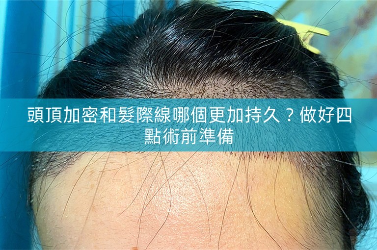 頭頂加密和髮際線哪個更加持久？做好四點術前準備