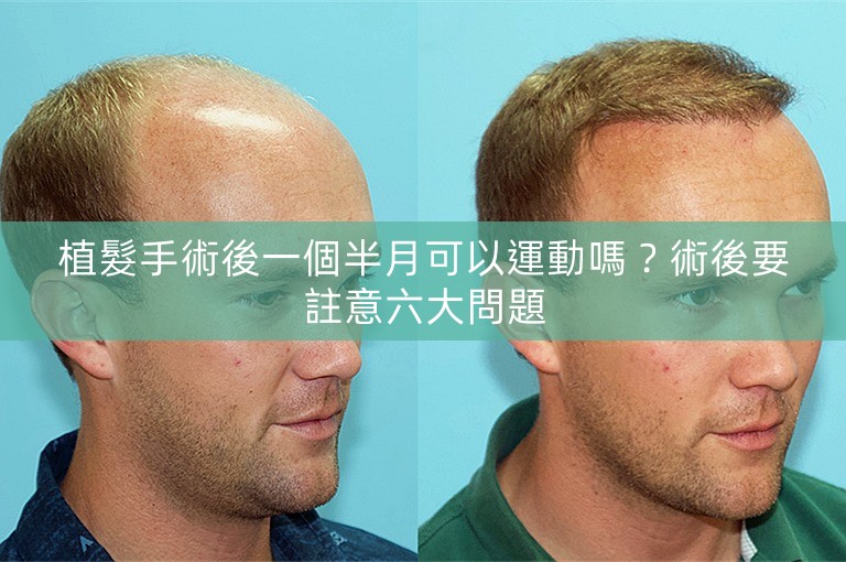植髮手術後一個半月可以運動嗎？術後要註意六大問題