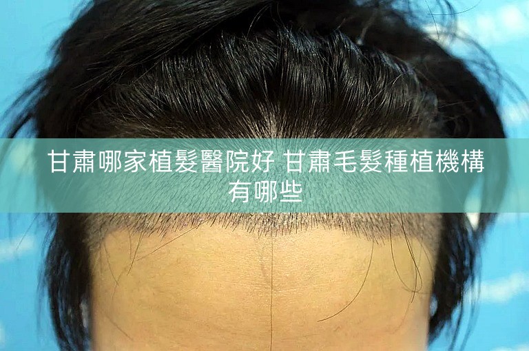 甘肅哪家植髮醫院好 甘肅毛髮種植機構有哪些