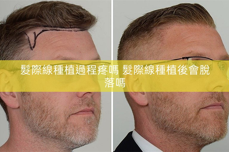 髮際線種植過程疼嗎 髮際線種植後會脫落嗎