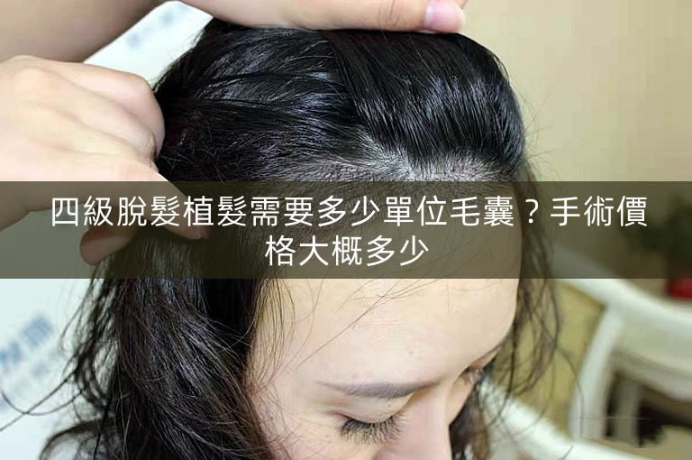 四級脫髮植髮需要多少單位毛囊？手術價格大概多少