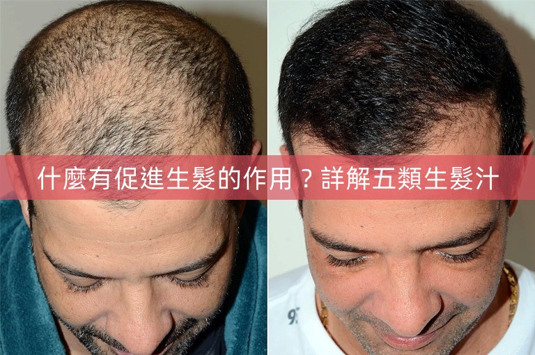 什麼有促進生髮的作用?詳解五類生髮汁 什麼有促進生髮的作用?詳解五類生髮汁