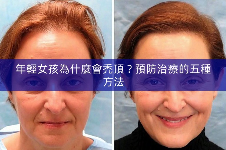 年輕女孩為什麼會禿頂？預防治療的五種方法