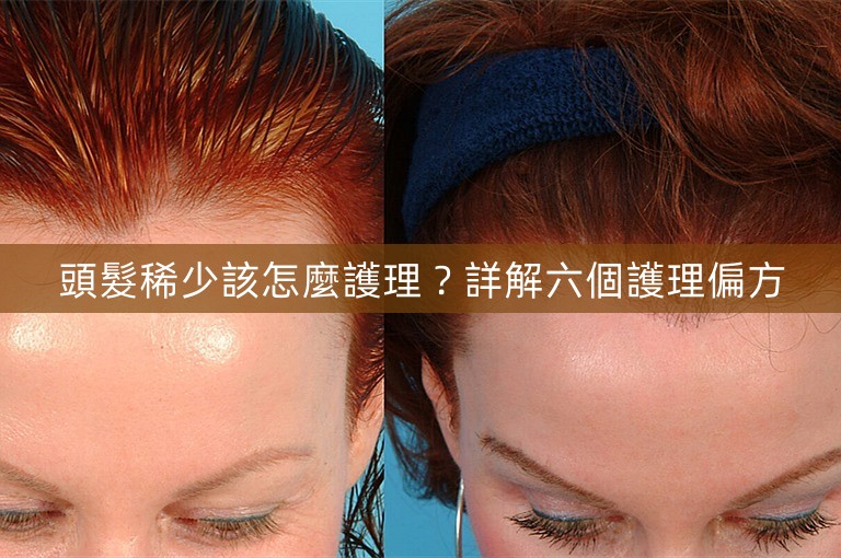 頭髮稀少該怎麼護理？詳解六個護理偏方