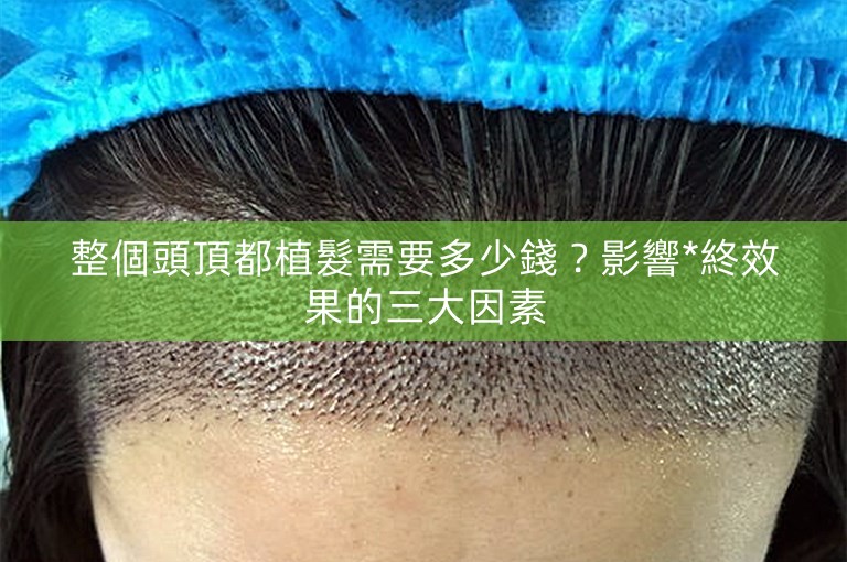 整個頭頂都植髮需要多少錢？影響*終效果的三大因素