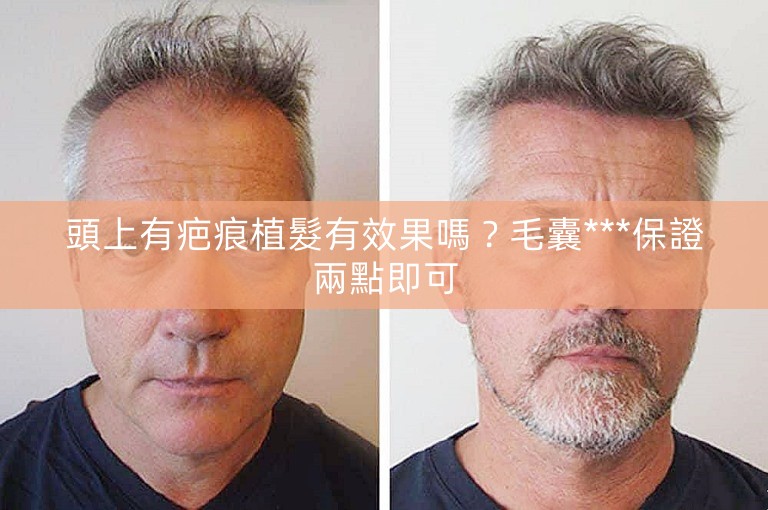 頭上有疤痕植髮有效果嗎？毛囊***保證兩點即可