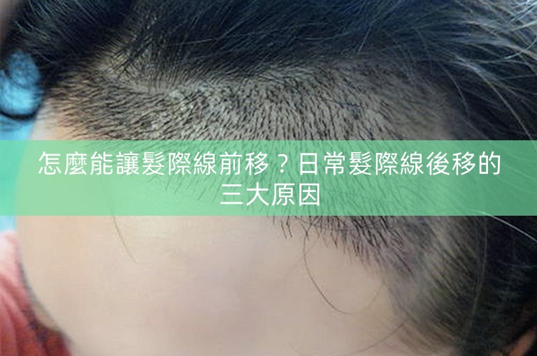怎麼能讓髮際線前移？日常髮際線後移的三大原因