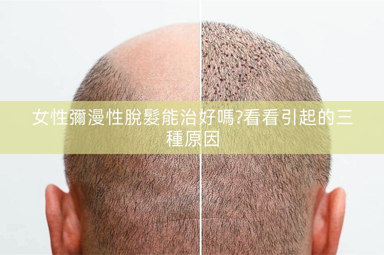 女性彌漫性脫髮能治好嗎?看看引起的三種原因