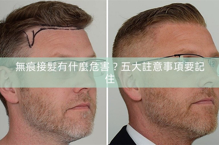 無痕接髮有什麼危害?五大註意事項要記住 無痕接髮有什麼危害?五大註意事項要記住