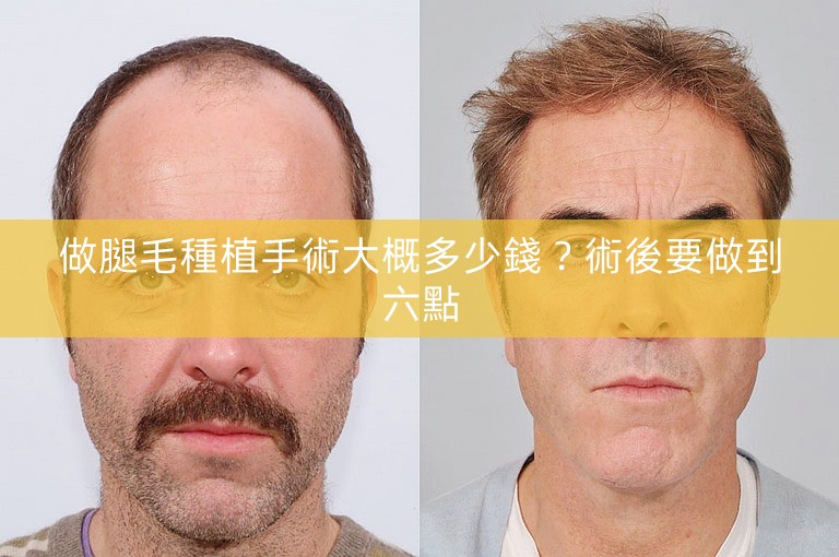 做腿毛種植手術大概多少錢?術後要做到六點 做腿毛種植手術大概多少錢?術後要做到六點