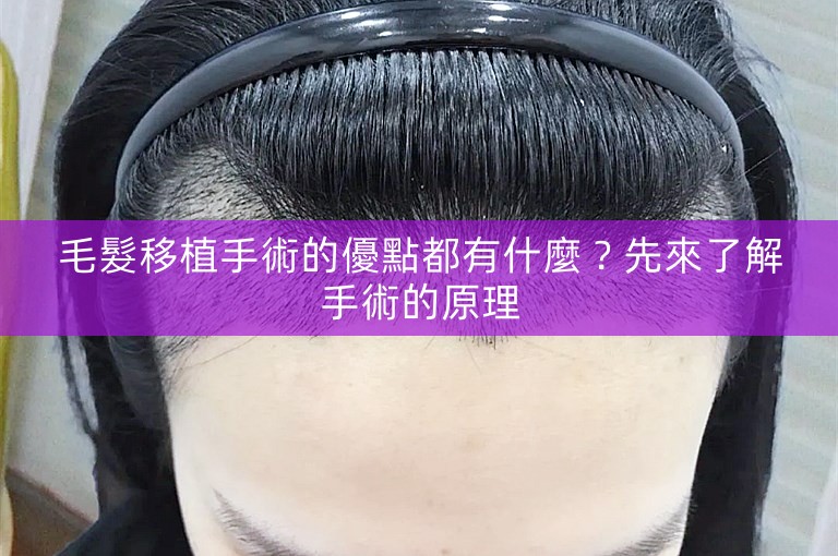 毛髮移植手術的優點都有什麼？先來了解手術的原理