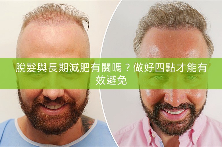 脫髮與長期減肥有關嗎？做好四點才能有效避免