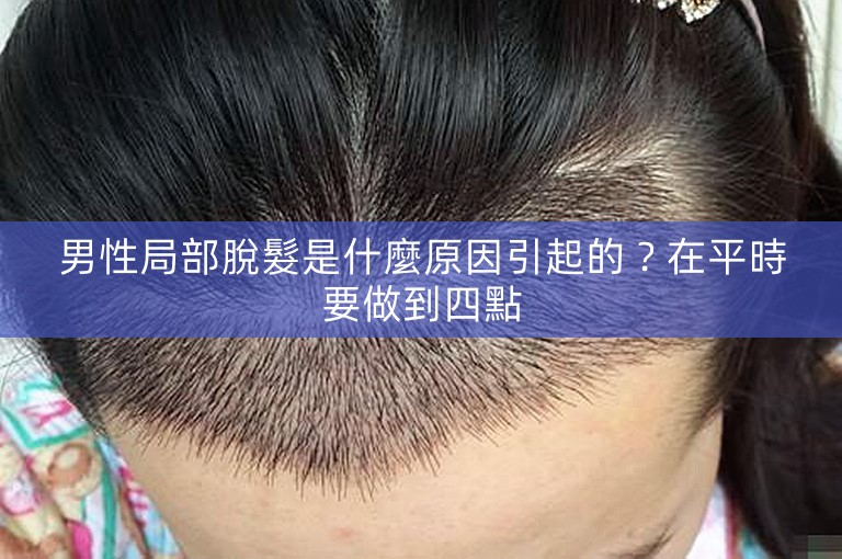 男性局部脫髮是什麼原因引起的？在平時要做到四點