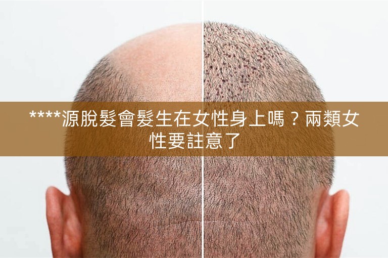 ****源脫髮會髮生在女性身上嗎？兩類女性要註意了