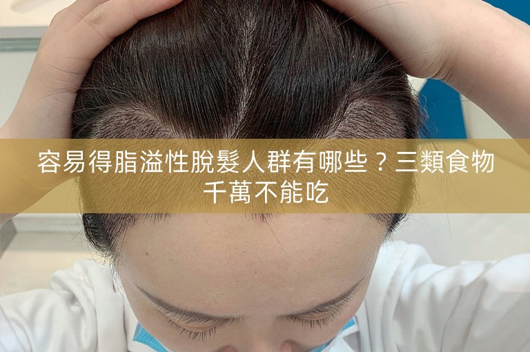 容易得脂溢性脫髮人群有哪些？三類食物千萬不能吃