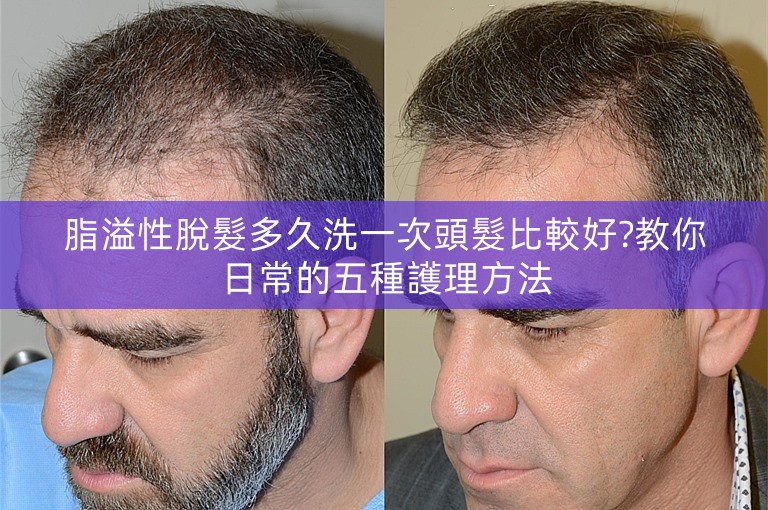 脂溢性脫髮多久洗一次頭髮比較好?教你日常的五種護理方法