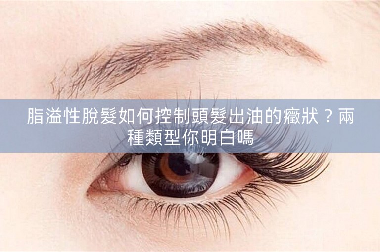 脂溢性脫髮如何控制頭髮出油的癥狀？兩種類型你明白嗎