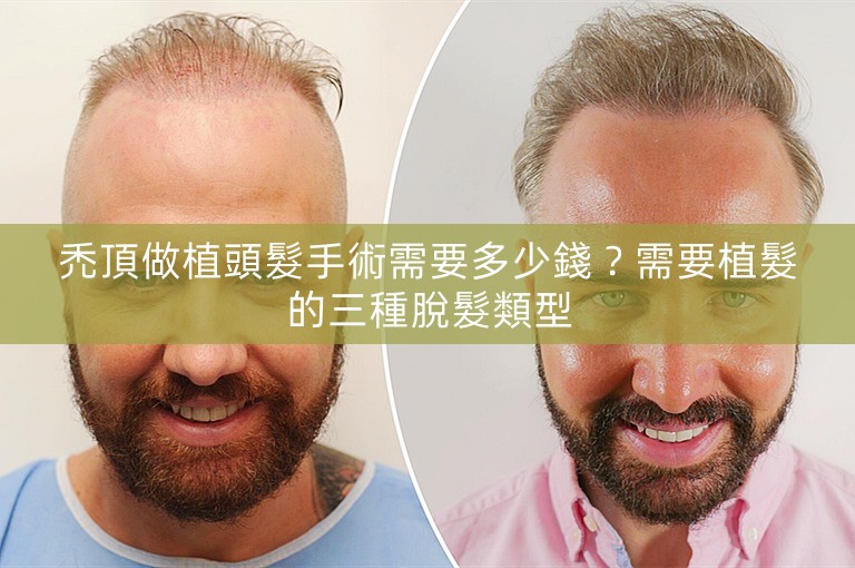 禿頂做植頭髮手術需要多少錢？需要植髮的三種脫髮類型