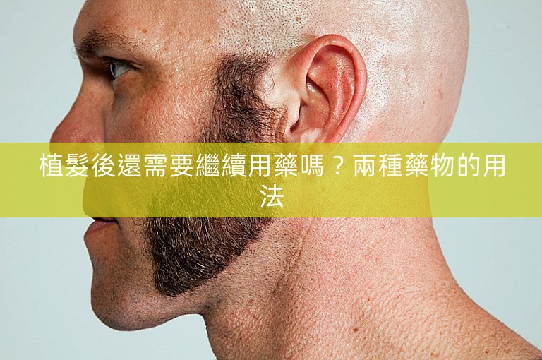 植髮後還需要繼續用藥嗎？兩種藥物的用法