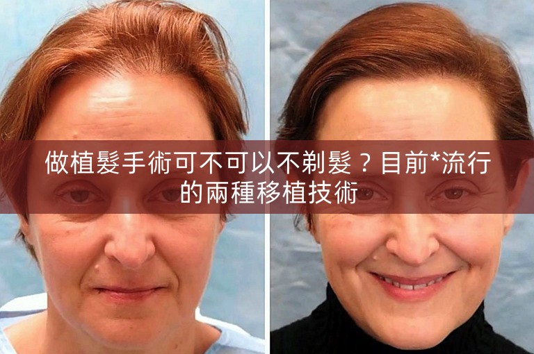 做植髮手術可不可以不剃髮?目前*流行的兩種移植技術 做植髮手術可不可以不剃髮?目前*流行的兩種移植技術
