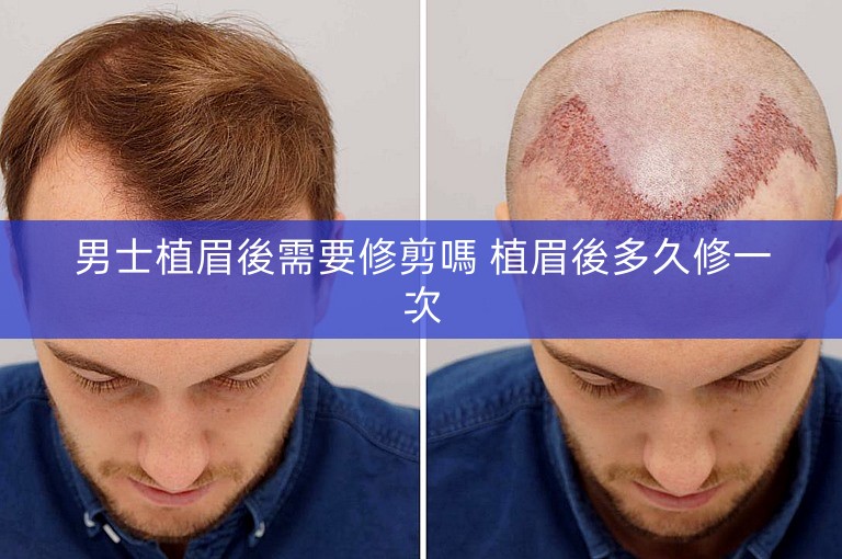 男士植眉後需要修剪嗎 植眉後多久修一次