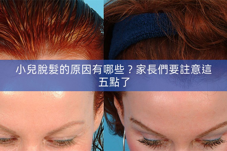 小兒脫髮的原因有哪些？家長們要註意這五點了