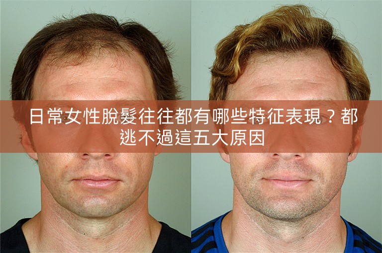 日常女性脫髮往往都有哪些特征表現？都逃不過這五大原因