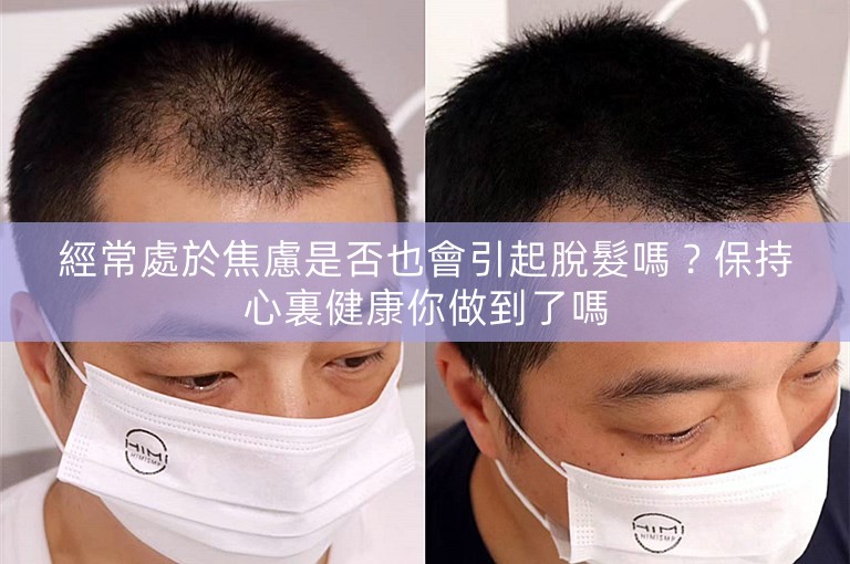 經常處於焦慮是否也會引起脫髮嗎？保持心裏健康你做到了嗎