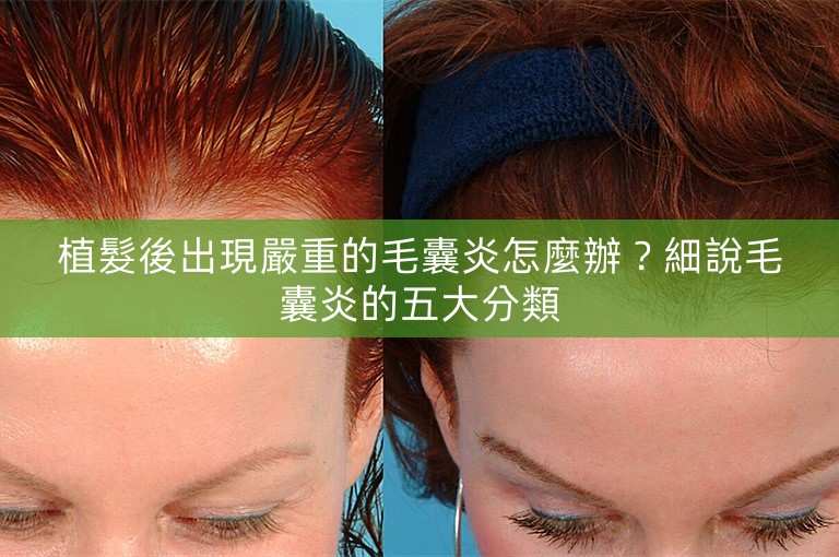植髮後出現嚴重的毛囊炎怎麼辦？細說毛囊炎的五大分類