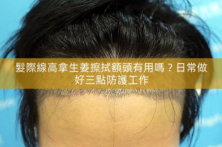 髮際線高拿生姜擦拭額頭有用嗎？日常做好三點防護工作