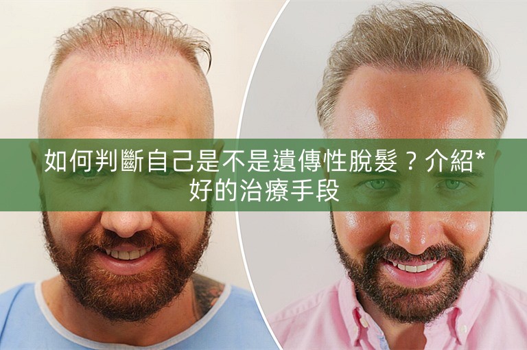 如何判斷自己是不是遺傳性脫髮？介紹*好的治療手段