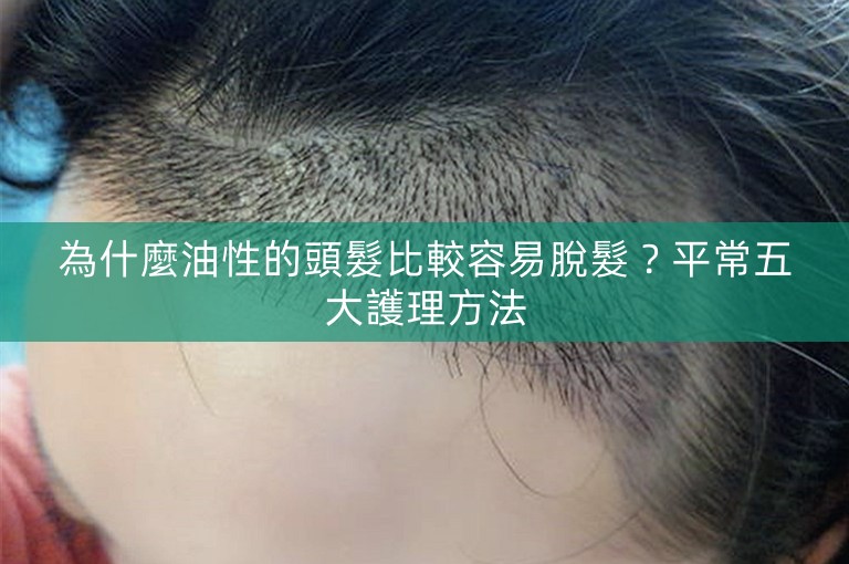 為什麼油性的頭髮比較容易脫髮？平常五大護理方法