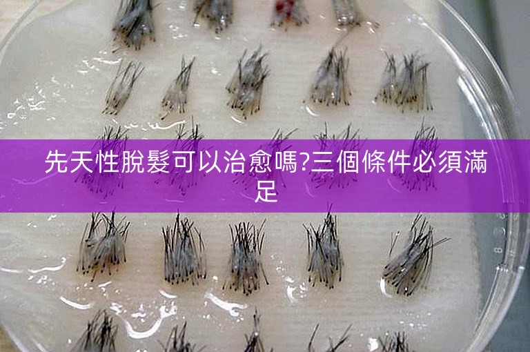 先天性脫髮可以治愈嗎?三個條件必須滿足