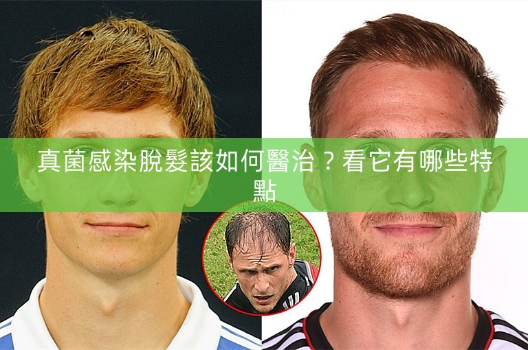 真菌感染脫髮該如何醫治？看它有哪些特點