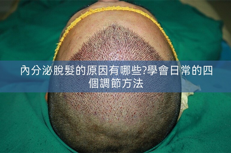 內分泌脫髮的原因有哪些?學會日常的四個調節方法