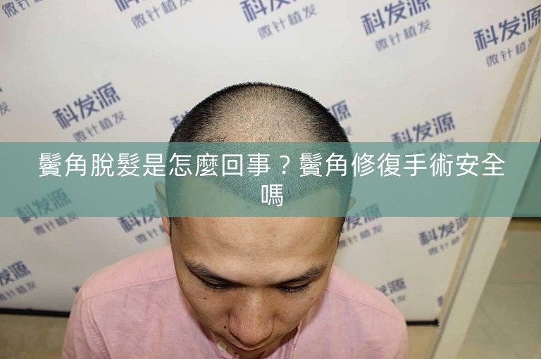 鬢角脫髮是怎麼回事？鬢角修復手術安全嗎