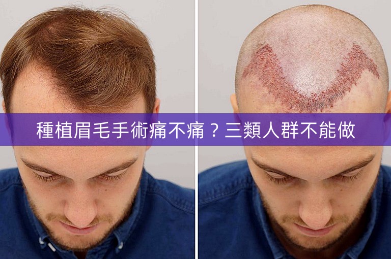 種植眉毛手術痛不痛？三類人群不能做