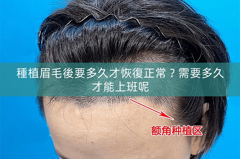 種植眉毛後要多久才恢復正常？需要多久才能上班呢