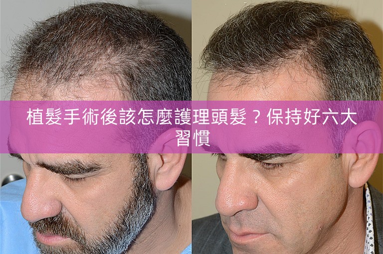 植髮手術後該怎麼護理頭髮？保持好六大習慣