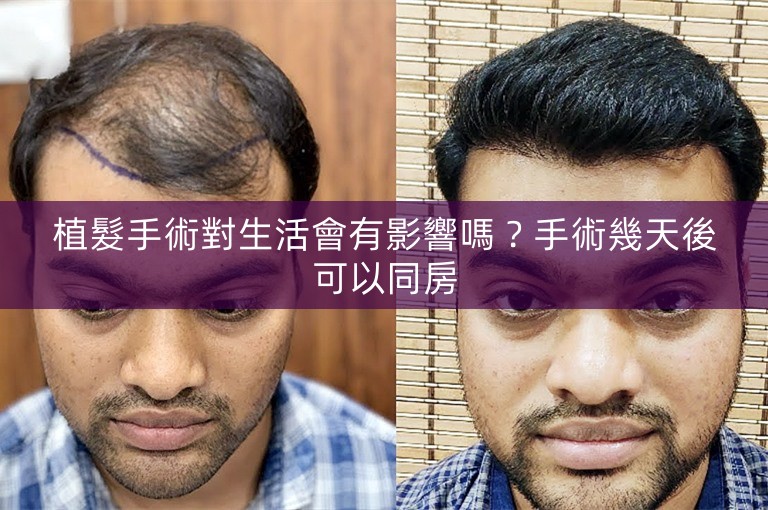 植髮手術對生活會有影響嗎？手術幾天後可以同房