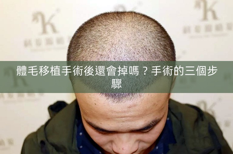 體毛移植手術後還會掉嗎？手術的三個步驟