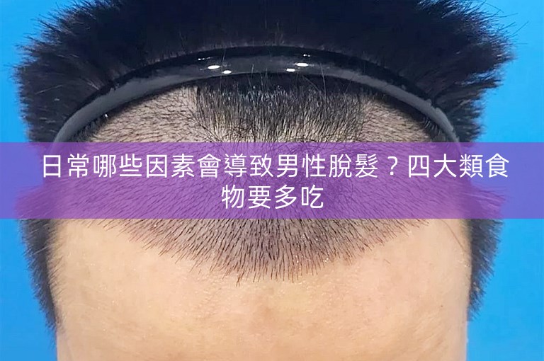 日常哪些因素會導致男性脫髮？四大類食物要多吃